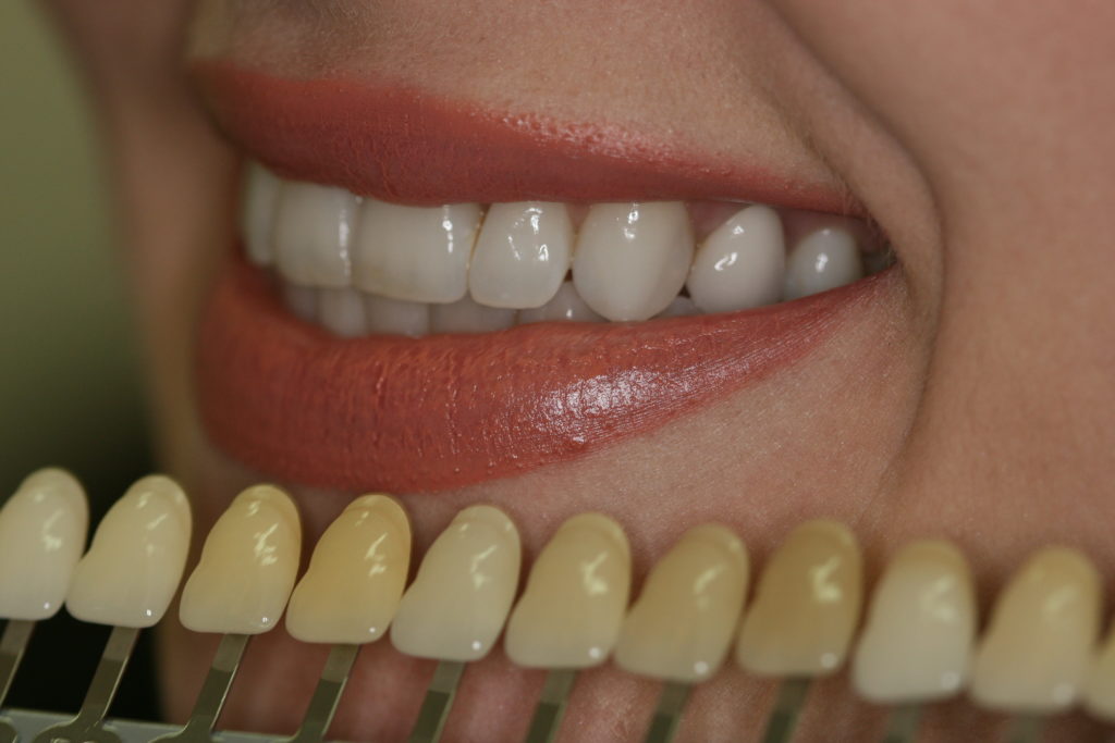 How Does Teeth Whitening Work? Expert London Dentist W11