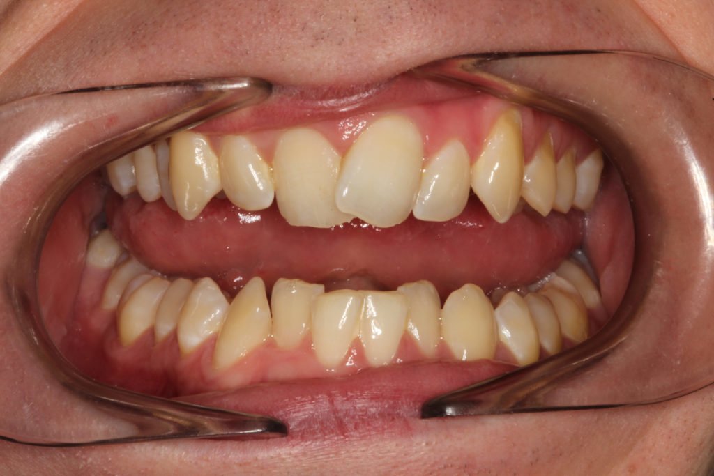 Invisalign Case Study - Holland Park Dental